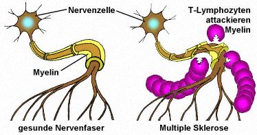Multiple Sklerose