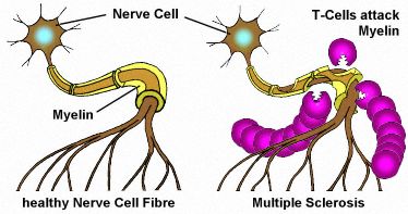 Multiple Sclerosis